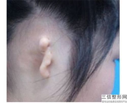 蚌埠做成耳朵畸形手術(shù)整形的年齡是多少