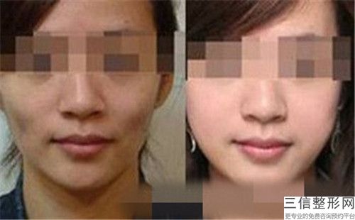 江門市改臉型整容術(shù)價格表已上線請查收-江門市中心醫(yī)院整形外科收費標(biāo)準(zhǔn)