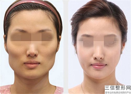 哪醫(yī)院做內推顴弓術推薦：內推顴弓術醫(yī)院前30名分享
