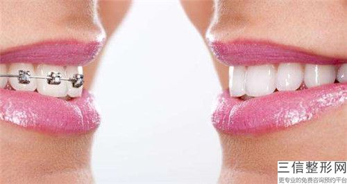 六安Hi-teeth牙齒美白手術(shù)大概需要價(jià)格是多少錢