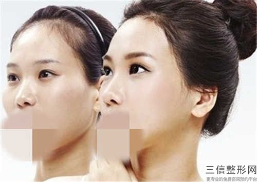 李小旦醫生下頜矯正實名推薦-萍鄉星悅醫美整形