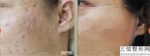 陳雙喜整形醫生切開填充法治療痤瘡瘢痕咋樣技術口碑項目科普坐診醫院信息一覽