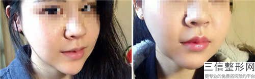濰坊做唇裂修補(bǔ)失敗修復(fù)整形的人群