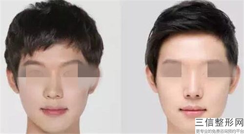 鹽城東方女子整形醫(yī)院整形費用表明細上線一覽-鼻孔朝天手術案例