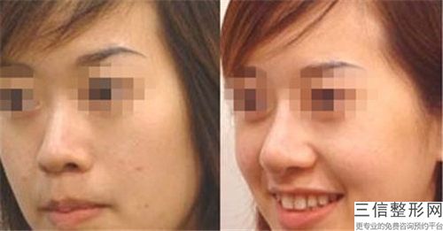 鎮(zhèn)江璀璨醫(yī)療美容診所奧美定隆鼻費用多少合理