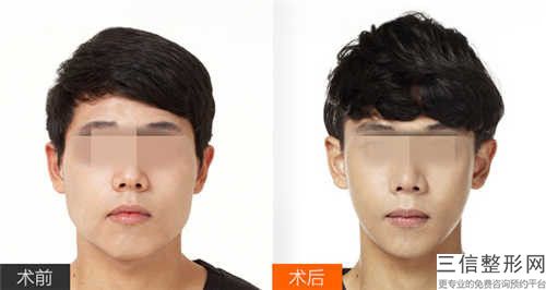 遼寧省微創頜骨手術醫生哪幾個效果好-曹國麗整形醫生前三上榜理由推薦閱讀