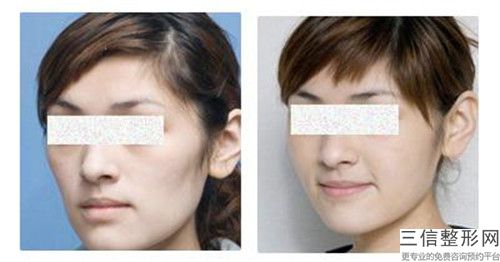 正規(guī)面部筋膜懸吊提升醫(yī)院推薦：面部筋膜懸吊提升醫(yī)院前30位集結