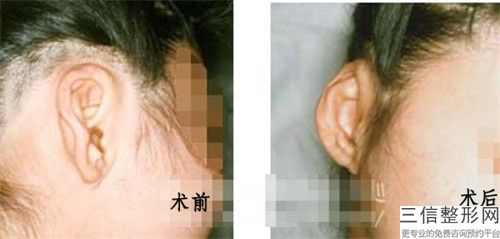 保山耳再造一期整形手術適用于哪些人