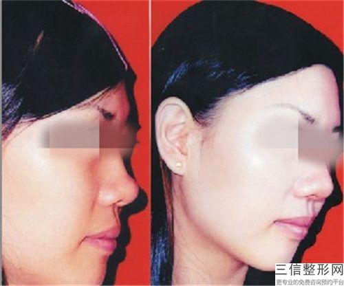 吉林省醫(yī)院自體脂肪隆下巴貴哪家好點-吉林大學(xué)第二醫(yī)院民康醫(yī)院網(wǎng)友票選說都不錯~