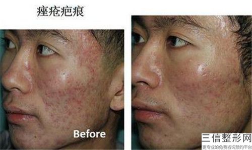 淄博友誼醫(yī)院醫(yī)療整形美容科整形價位表新鮮大出爐-激光疤痕案例