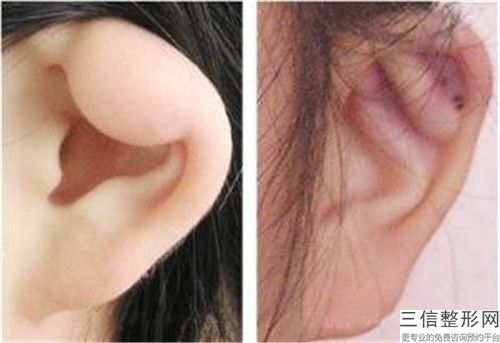 整形醫(yī)院耳朵做支架推薦：耳朵做支架醫(yī)院前30佳權(quán)威綜合
