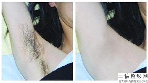 乳房冰點脫毛手術多久起效果,乳房冰點脫毛效果能保持嗎