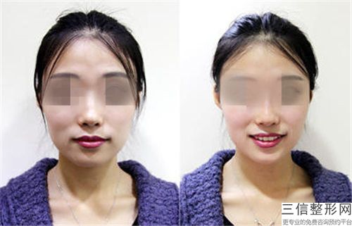 吉林張秀珍醫(yī)療美容外科診所價(jià)格收費(fèi)表公布2025供參考-整形鼻修復(fù)案例