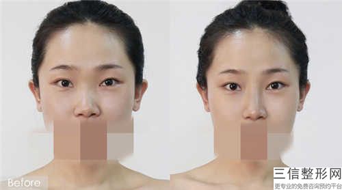 李華榮醫生顴弓內推案例-價格價位表全新一期發布