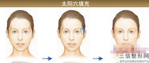 黑龍江省好一點的太陽穴填充術醫(yī)院(雙鴨山佰億醫(yī)療美容診所大牌子資質各方面放心~)