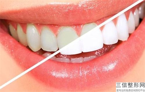 濱州牙齒根部吸收矯正的優(yōu)點(diǎn)和適應(yīng)人群