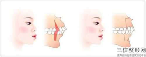 荊州Clearcorrect牙套矯正術的作用如何能維持多久
