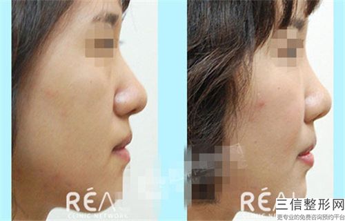 中國鼻中軟骨歪矯正醫院推薦：鼻中軟骨歪矯正醫院前50佳權威披露