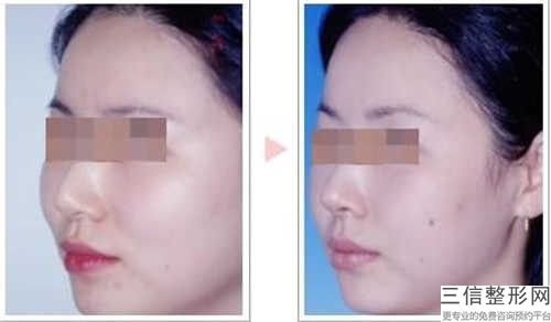 磨骨下頜角手術醫院推薦：磨骨下頜角手術醫院前30強效果盤點