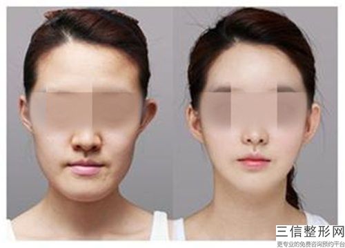 萊蕪艾美醫療美容整形醫院整形價位表2025熱門新編-抽脂隆下巴案例