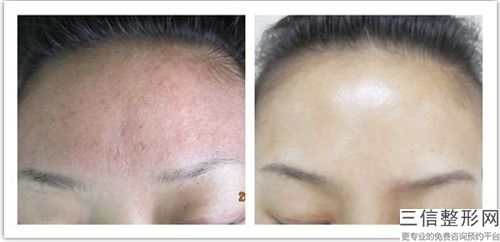 牡丹江王維群整形美容外科費(fèi)用表明細(xì)整容發(fā)布-激光咖啡斑去除案例