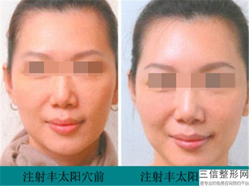 忻州市忻府區維多利亞美容整形太陽穴凹進去填充需要價格多少呢