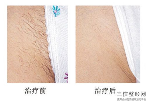 楚雄彝族自治州做毛發移植價格(價目)全新呈現-楚雄彝族自治州做毛發移植手術費用怎樣