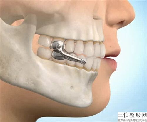 泉州德國(guó)ht種植牙需要注意些什么安全事項(xiàng)