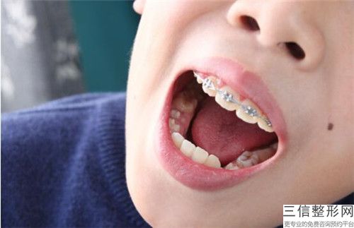 齊齊哈爾牙齒微調手術的效果明顯嗎