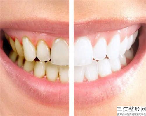 襄陽牙齒過敏修復作用是否持久