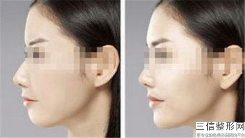 美容醫院耳廓整型手術推薦：耳廓整型手術醫院前30名名次盤點