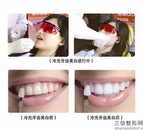 寶雞小白兔口腔醫(yī)院全口種植牙橋架的安全性問題