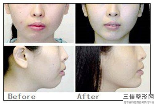 張家界emax牙齒貼面手術方法安全