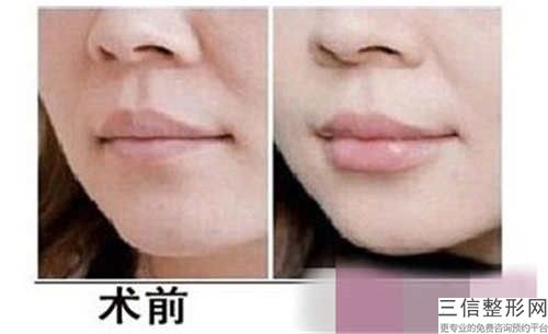 常熟圣莎拉美容整形醫院陰唇肥大割除手術價格會不會很貴呢