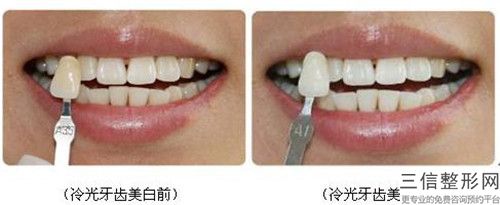 陽江牙齒搭橋術術后的后遺癥有哪些