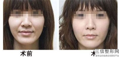botox去除川字紋后的后期護理