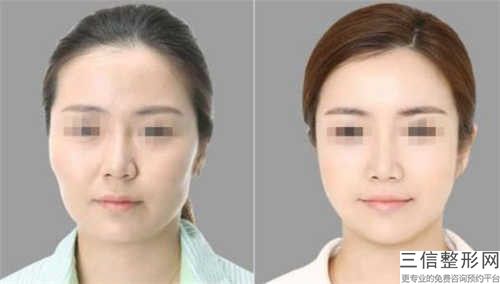 巴彥淖爾顴骨高做磨骨手術(shù)適應(yīng)的人群有哪些