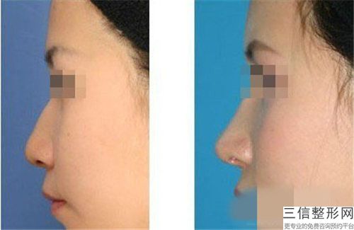 中國鼻小柱歪斜矯正醫(yī)院推薦：鼻小柱歪斜矯正醫(yī)院前50更新出爐