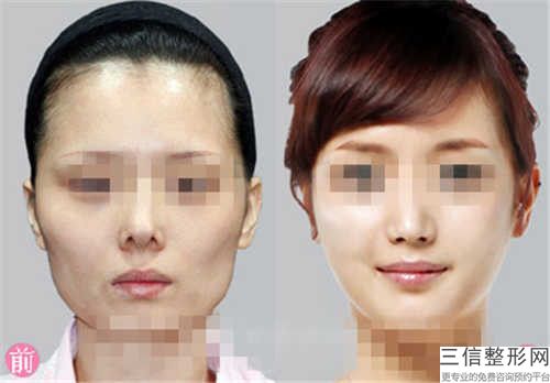 高顴骨整形后要如何護理恢復快