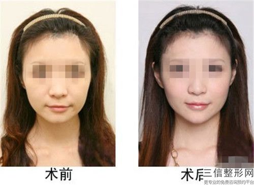 玻尿酸注射蘋果肌術術的效果和副作用
