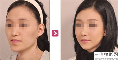 資陽貝齒口腔醫院面部整形豐太陽穴后遺癥的具體表現及處理方法