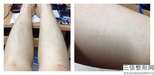 邵陽曹家醫療美容醫院冰晶脫毛整形手術的效果好