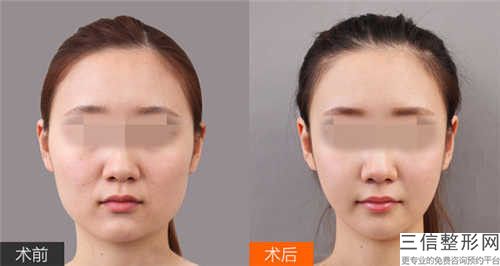 云浮上頜智齒拔除術美容有什么危害