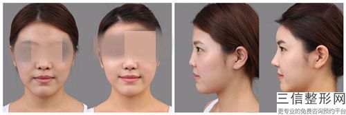 中國整形醫院鼻翼去薄術多少錢：鼻翼去薄術醫院50強口碑榜公布