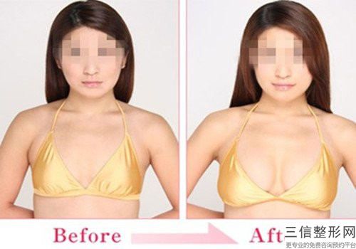薛鐵華乳頭凹陷整形手術風險問題怎么處理