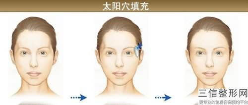 曾德浩膠原蛋白豐太陽穴有風險嗎能避免嗎