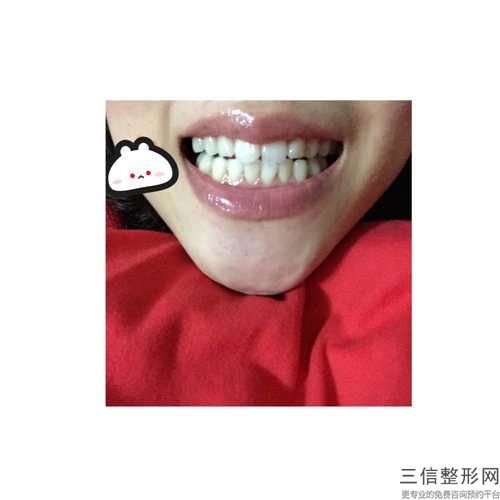 齙牙做美容冠整形手術(shù)適用人群和優(yōu)勢(shì)