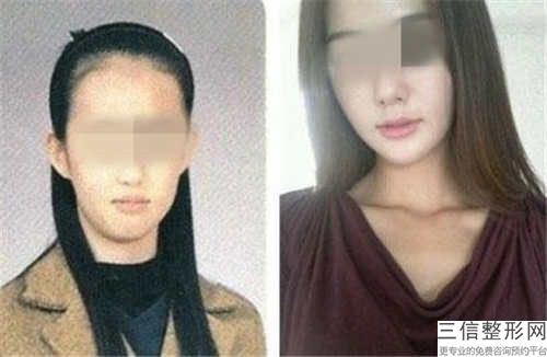 本溪做豐唇手術哪些適合人群