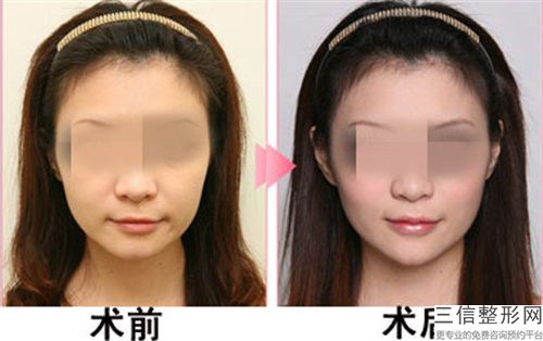 全國的微整形注射下巴醫院：微整形注射下巴醫院top50哪幾個效果好