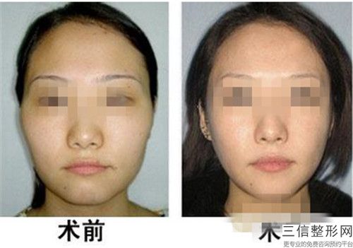 自體脂肪填充蘋果肌的術后效果怎樣